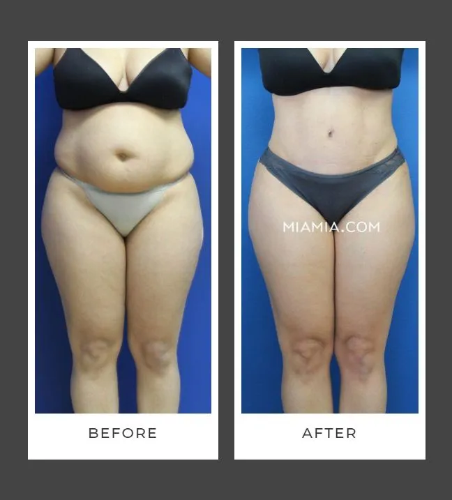 Tummy Tuck Before & After Banner